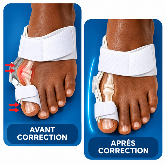 Orthèses correctrices pour hallux valgus - Soulagez la pression et l’inconfort du gros orteil
